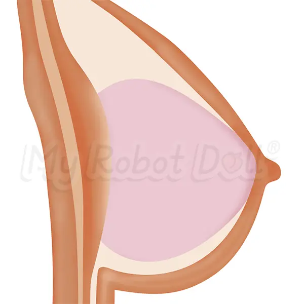 Gel-Filled Breast