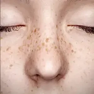 Freckles